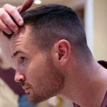 How to Find Cheap Hair Transplants