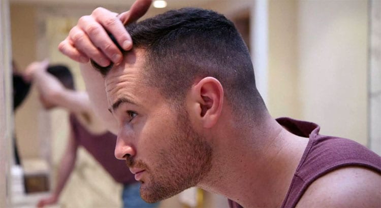 How to Find Cheap Hair Transplants