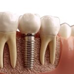 Could it be Really Cheaper to get Dental Implants Overseas in 2023?