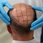 Reasons To Consider A Hair Transplant In Turkey 2023