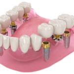 Finding the Cheapest Countries to get Dental Implants Abroad