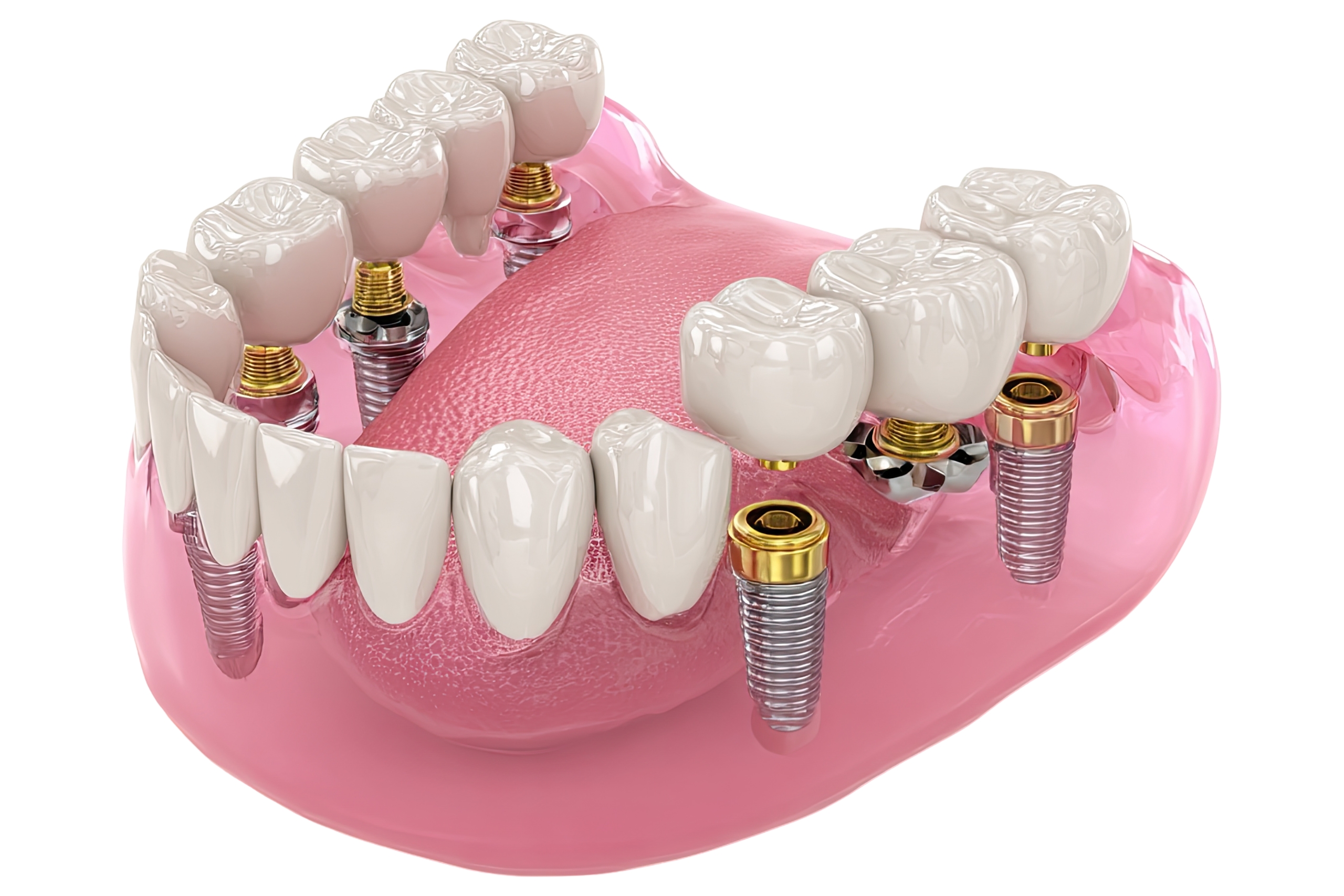 Finding The Cheapest Countries To Get Dental Implants Abroad